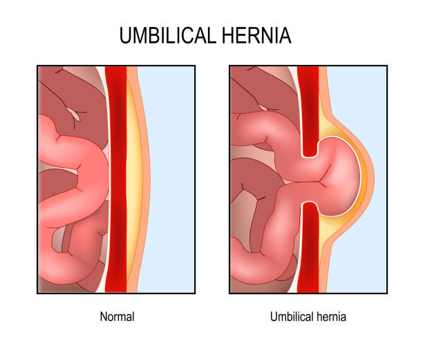 Umbilical hernia. Cross section of abdomen with small intestine Umbilical hernia. Cross section of abdomen with small intestine, muscle and abdominal wall. Normal human's belly and muscle rupture with hernial sac. Vector poster abdominal cavity stock illustrations