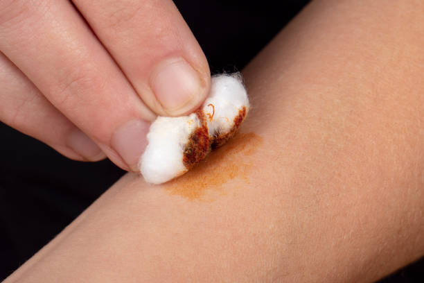 cauterization of a wound on the arm with an iodine solution and cotton wool, health skin care cauterization of a wound on the arm with an iodine solution and cotton wool, health skin care. antiseptic stock pictures, royalty-free photos & images