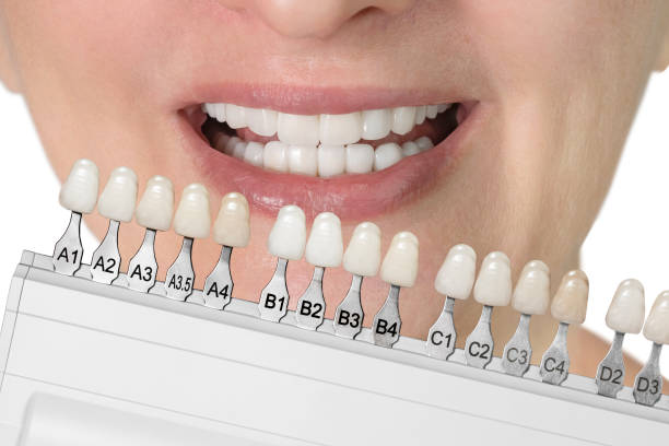 perfect white smile with shade guide bleach color tooth dental whitening isolated on white