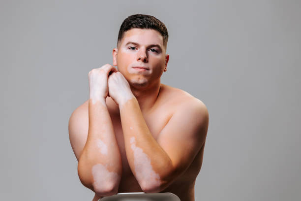 istock Beauty inside, confident vitiligo man is photographed in the studio as a model. 1437067579