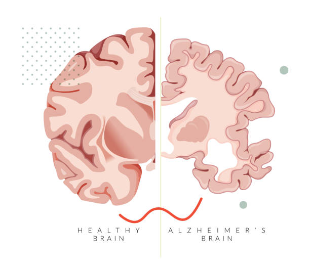 ilustraciones, imágenes clip art, dibujos animados e iconos de stock de enfermedad de alzheimer - sección transversal cerebral comparar con cerebro sano - ilustración - mri scan brain alzheimers disease medical scan