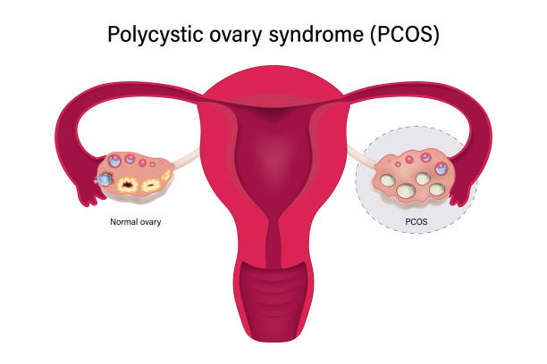 Polycystic ovary syndrome PCOS. Multiple immature follicles vector. Ovarian cysts with female reproductive system. Polycystic ovary syndrome PCOS. Multiple immature follicles vector. Ovarian cysts with female reproductive system. Polycystic ovary syndrome stock illustrations