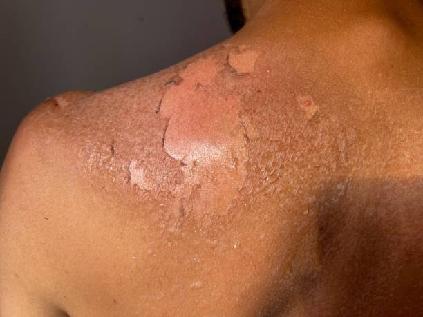 istock Peel back and shoulder skin from sunburn effect on young man body 1437242661