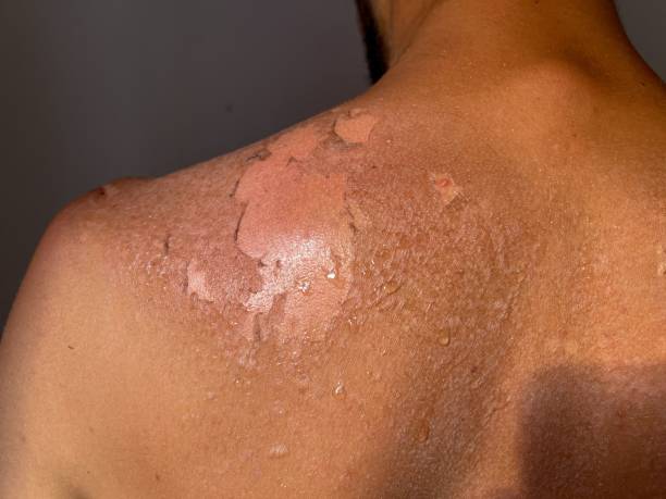 istock Peel back and shoulder skin from sunburn effect on young man body 1437242663