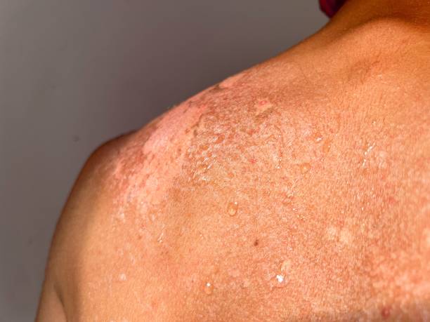 istock Peel back and shoulder skin from sunburn effect on young man body 1437242672