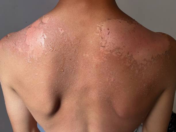 istock Peel back and shoulder skin from sunburn effect on young man body 1437242702