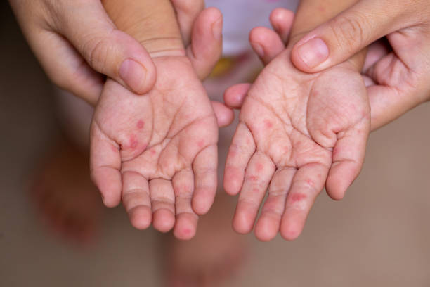 Parents hold the hands of a child with HFMD stock photo