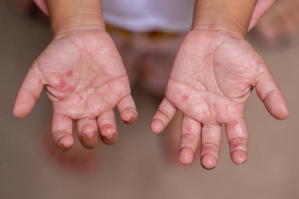 istock hand of a child with HFMD 1437267020