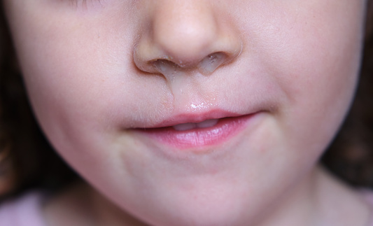 close-up of a girl's runny nose caused by a seasonal virus