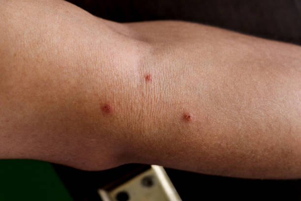 istock Allergy concept. Young man with pimples 1437493337