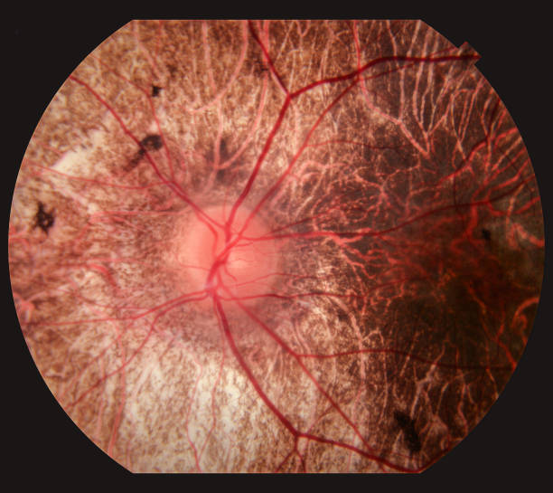 istock Human Eye Retina Showing Vane and disease 1437495721