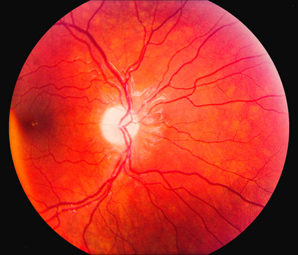 istock Human Eye Retina Showing Vane and disease 1437495744