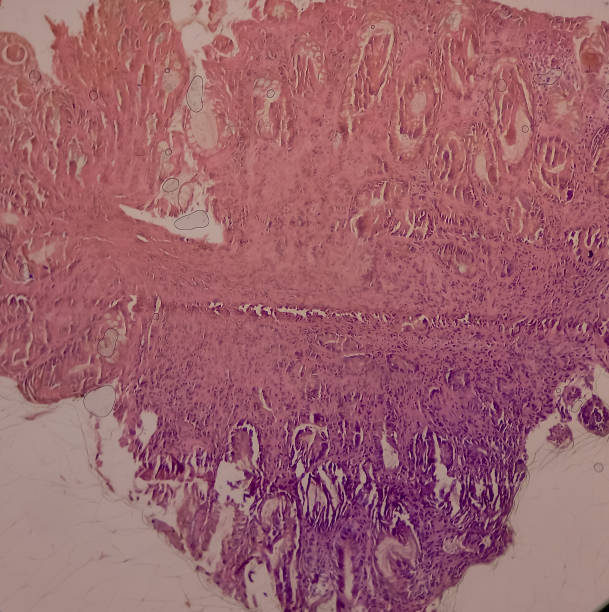 Sigmoid colon(colonoscopic biopsy): Chronic nonspecific colitis. Show colonic mucosa, chronic inflammatory cells infiltration in the lamina propria. IBD. Sigmoid colon(colonoscopic biopsy): Chronic nonspecific colitis. Show colonic mucosa, chronic inflammatory cells infiltration in the lamina propria. IBD. lamina propria stock pictures, royalty-free photos & images