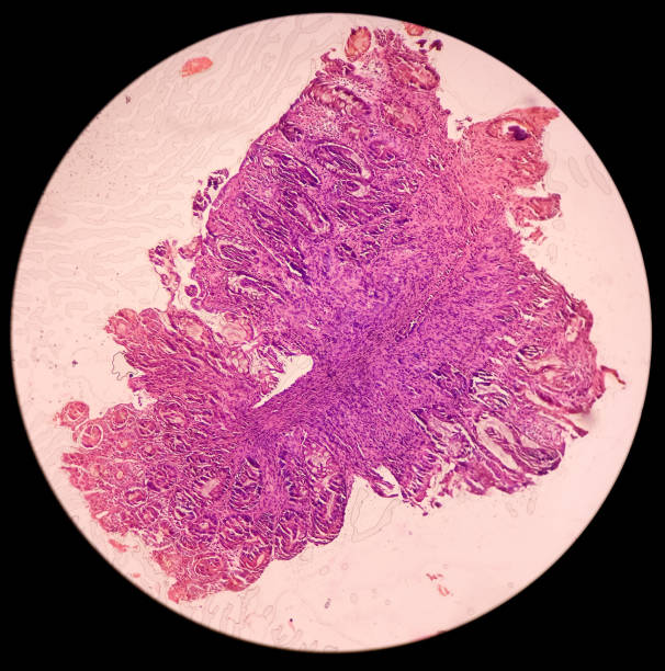 Sigmoid colon(colonoscopic biopsy): Chronic nonspecific colitis. Show colonic mucosa, chronic inflammatory cells infiltration in the lamina propria. IBD. Sigmoid colon(colonoscopic biopsy): Chronic nonspecific colitis. Show colonic mucosa, chronic inflammatory cells infiltration in the lamina propria. IBD. lamina propria stock pictures, royalty-free photos & images