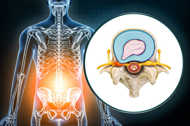 Lumbar hernia and vertebra with herniated disc medical diagram 3D rendering illustration. Backache, spine pathology, injury, osteology, healthcare, science concepts. stock photo