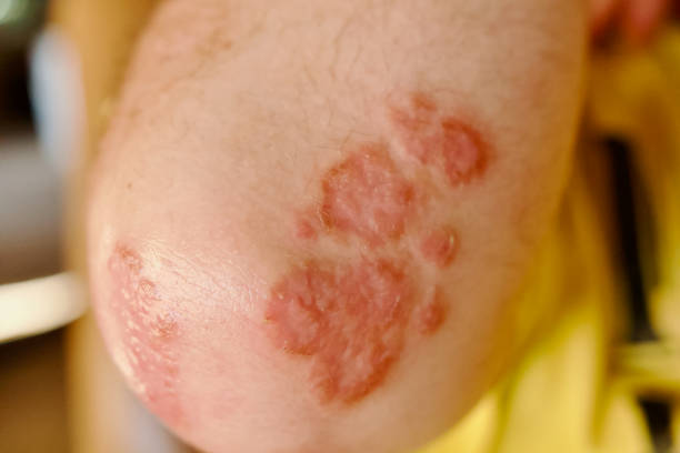 Rash on Skin Covid Vaccine Rash on Skin endocarditis stock pictures, royalty-free photos & images