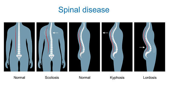 Spinal disease. types of spine defects. Human Skeleton and bones. Vertebral column disorders. Normal spine and Spinal deformity from Scoliosis to Lordosis and Kyphosis. Vector illustration like x-Ray image. Anterior and lateral view. infographics