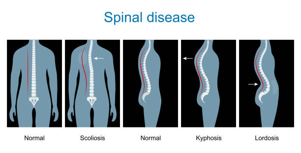Normal spine and Spinal deformity from Scoliosis to Lordosis and Kyphosis. Spinal disease. types of spine defects. Human Skeleton and bones. Vertebral column disorders. Normal spine and Spinal deformity from Scoliosis to Lordosis and Kyphosis. Vector illustration like x-Ray image. Anterior and lateral view. infographics kyphosis stock illustrations