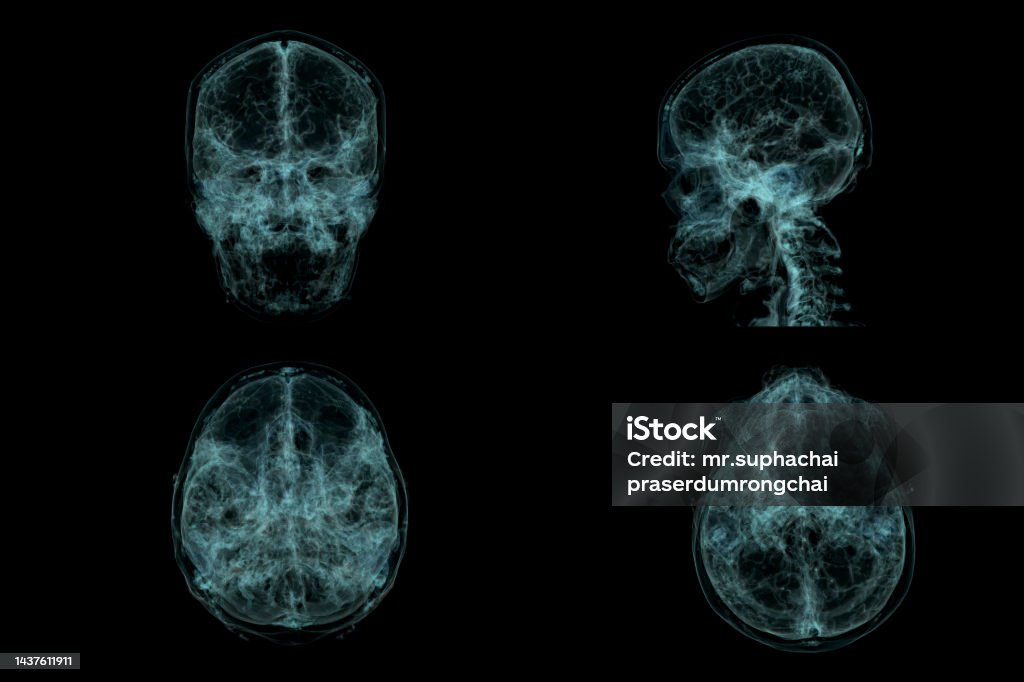 Skull Scan Human Skull Brain By Ct Scan Xray Visualization Inside Of Skull 3d ...