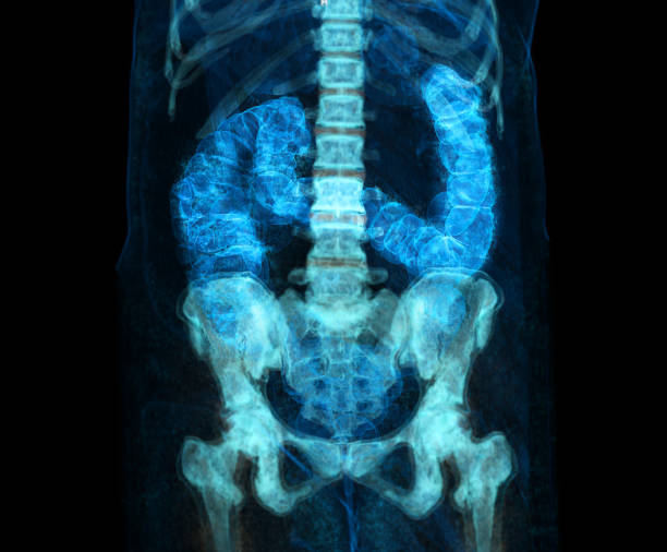 대장 암 스크리닝을위한 ct 대장 촬영 또는 결장 3d 렌더링 이미지의 ct 스캔. 대장 암 검진을 확인하십시오. - descending colon 뉴스 사진 이미지