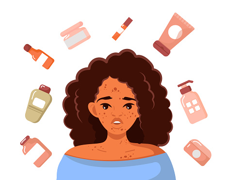 A young African-American woman with problematic skin. Pimples and acne. A woman surrounded by special cosmetics for skin care. Protecting the skin of the face and preserving beauty. Vector illustration.