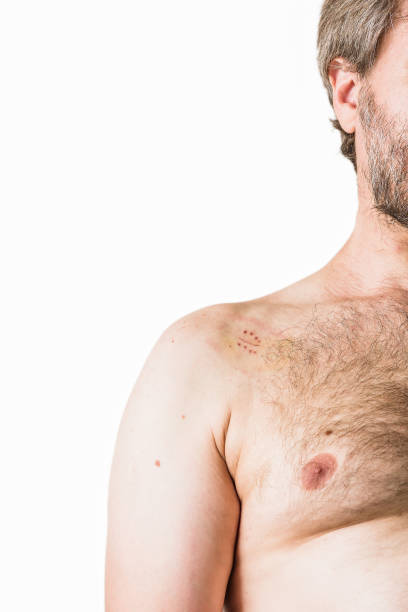 istock shoulder arthroscopic surgery operation. metal staple suture traumatologist treatment. man 1437988715