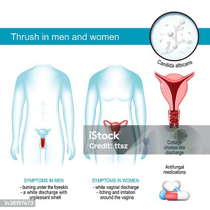 istock Thrush in men and women. yeast infection. 1438197673