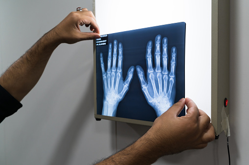Human hands holding hands x-ray film.