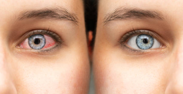 у женщины красные глаза до и после лечения глазных капель - conjunctiva стоковые фото и изображения