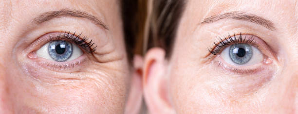 istock comparison before and after face wrinkles and crow's feet removal 1438363523