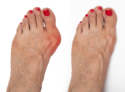 lady's bare foot before and after surgery to correct hallux valgus. Isolated on white background with and without bumion