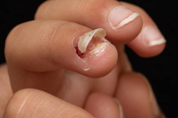 istock Finger nail come-off after injury or disease 1438393452