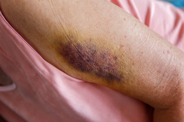 Large dark bruises  or hematoma on arm of an elderly person. Painful accident. stock photo