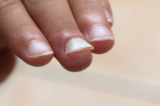 istock fingers of a child who is losing a fingernail 1438440310
