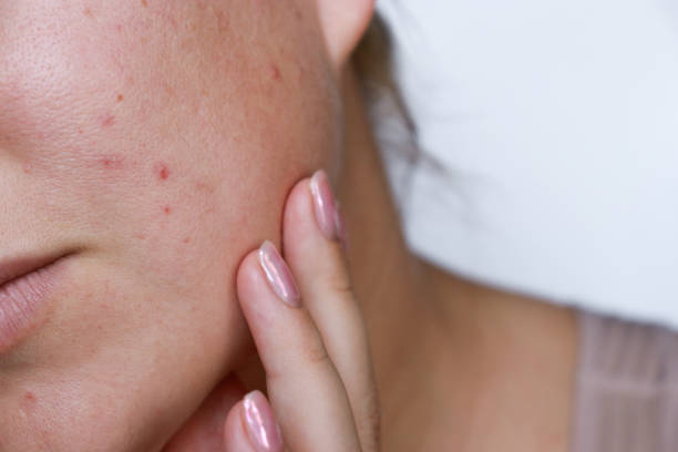 close up natural woman bad acne skin with scars close up natural woman bad acne skin with scars acne stock pictures, royalty-free photos & images