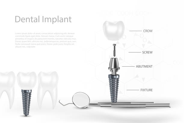 3D Dental Implants Surgery Concept with Tool. 3D Dental Implants Surgery Concept with Tool dentist backgrounds stock illustrations