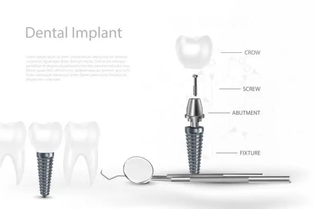 Vector illustration of 3D Dental Implants Surgery Concept with Tool.