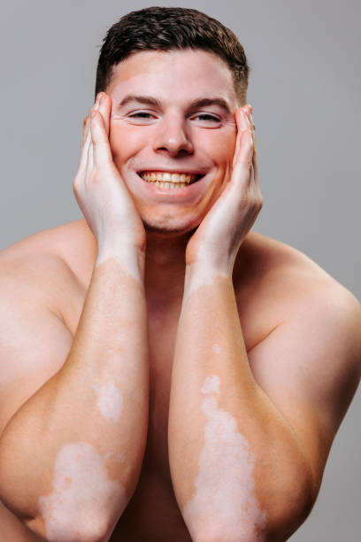 istock Young man vitiligo smile broadly looking at camera enjoy while sit chair studio gray background. 1438571384
