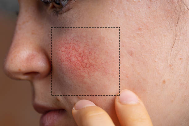primo piano di arrossamento della rosacea sulla pelle della guancia di una giovane donna - naso rosso foto e immagini stock