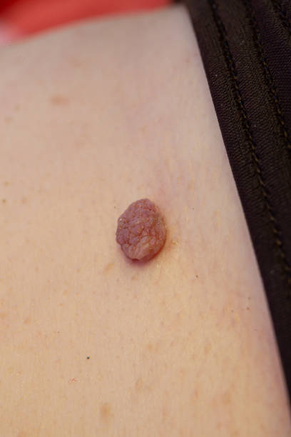 istock Large swollen mole on a woman's skin 1438606334