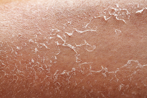 Details of a woman's dry skin. Exfoliation after dehydration due to exposure to sunlight