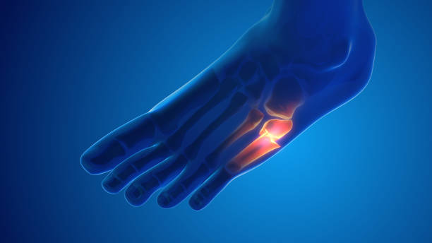 istock Fracture foot bone pain medical concept 1438918683
