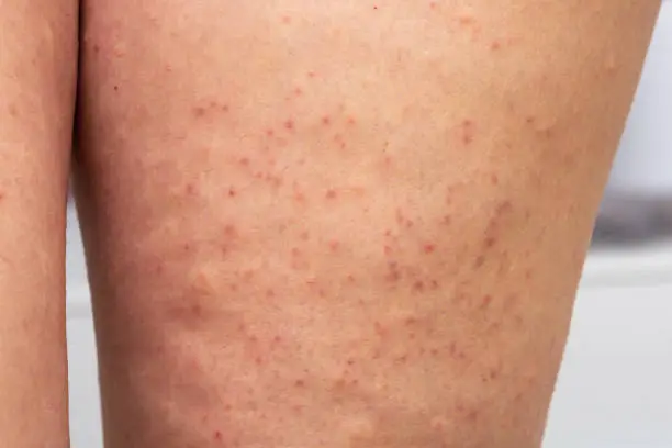 close-up of woman's legs with keratosis pilarar, an acute folliculitis causing pinpoint redness, dermatological care concept