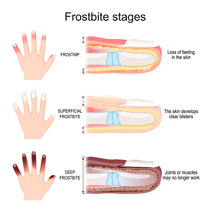 Frostbite stages of fingers. From Frostnip with Loss of feeling in the skin to Deep Frostbite of Joints and muscles. Vector illustration