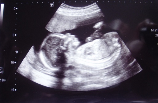 A closeup shot of an obstetric ultrasonography