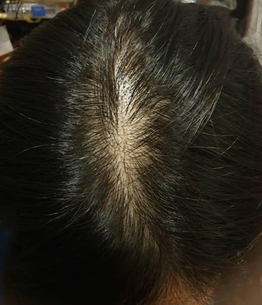 istock alopecia / hair loss 1439208470
