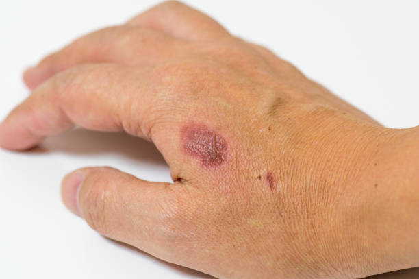 istock A man's hand with a painful burn wound 1439223018