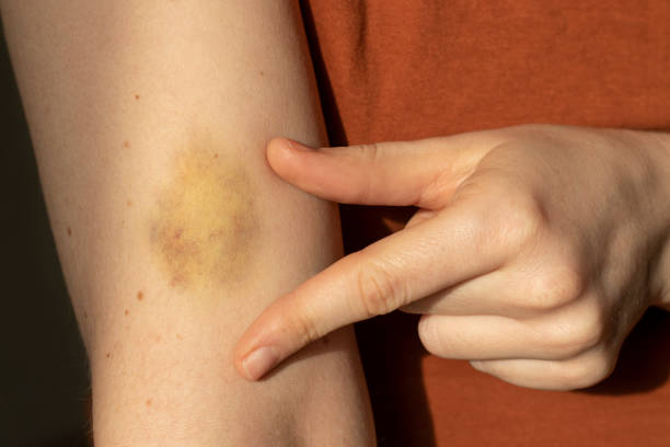 istock A bruise on a woman's arm. 1439236891