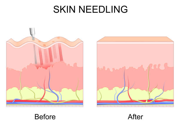 microneedling. skin needling. microneedling. skin needling. Before and after cosmetic procedure. Cross section of layers of a human skin with wrinkles. Close-up of Process of dermarolling. Collagen induction therapy. vector poster epidermal cell stock illustrations