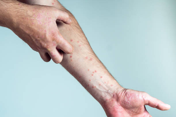 istock Unrecognizable man suffering from psoriasis scratching thick clusters, flaky rash on skin of arm with affected fingers. 1439330664